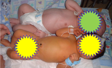 儿科 | 黄疸对宝宝的影响