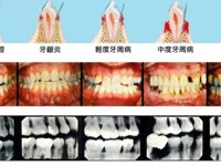 口腔科 | 关于洗牙的科普知识——牙周病