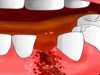 口腔科 | 干槽症的病因及治疗方法