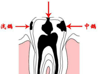 口腔科 | 什么是龋病（蛀牙）？