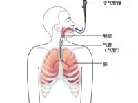 支气管镜