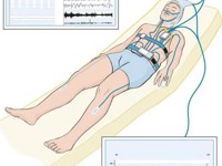 多导睡眠监测