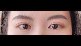 重睑、睑袋、隆鼻、除皱、腋臭等常规整形美容手术