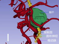 神经外科 | 这个男人很调皮，挤眉弄眼“做鬼脸”？