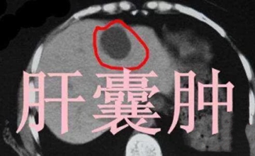 肝病科 | 体检发现肝囊肿怎么办？
