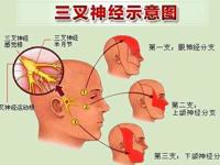 神经外科 | 球囊压迫术治疗三叉神经痛