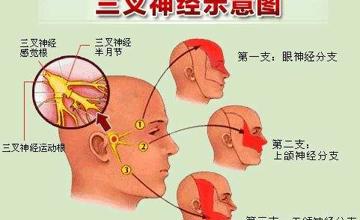神经外科 | 球囊压迫术治疗三叉神经痛
