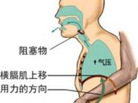 急诊医学科 | 生命的拥抱，海姆立克急救法！