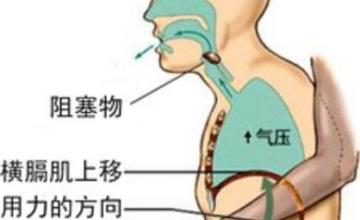 急诊医学科 | 生命的拥抱，海姆立克急救法！