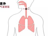 重症医学科 | 气道异物梗阻急救科普知识