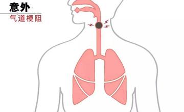 重症医学科 | 气道异物梗阻急救科普知识