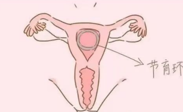 妇科 | 节育环不取，会长到肉里吗？什么时候合适取环？