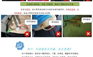 肝胆外科丨携T管出院患者居家护理手册