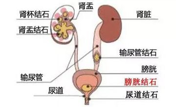 泌尿外科 | 泌尿系结石科普