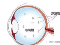 眼科 | 眼前“虫子”飞，到底为哪般？