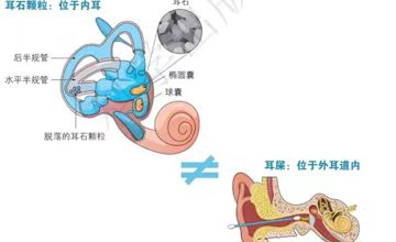 一动就晕，咋回事，带你了解“耳朵里的石头”